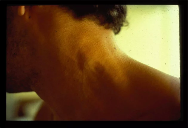 BRUとして知られる患者の写真。彼のリンパ節の腫れは、彼がエイズの初期段階にあることを示した。 BRUとして知られる患者の写真。彼のリンパ節の腫れは、彼がエイズの初期段階にあることを示した。© ウィリー・ローゼンバウム