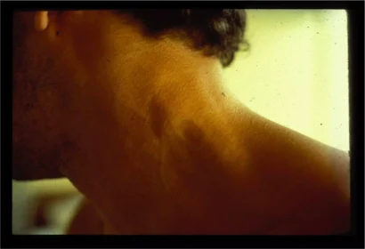 BRUとして知られる患者の写真。彼のリンパ節の腫れは、彼がエイズの初期段階にあることを示した。© ウィリー・ローゼンバウム 